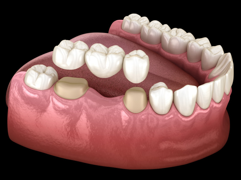 Your Smile with Reliable Dental Bridges