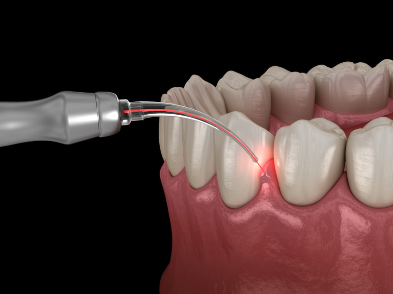 Restore your Gum Health