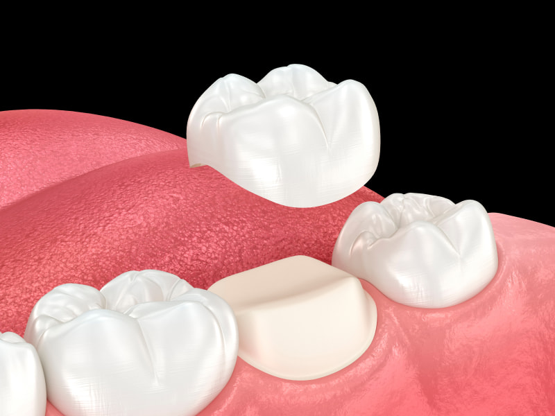 Restore Your Teeth